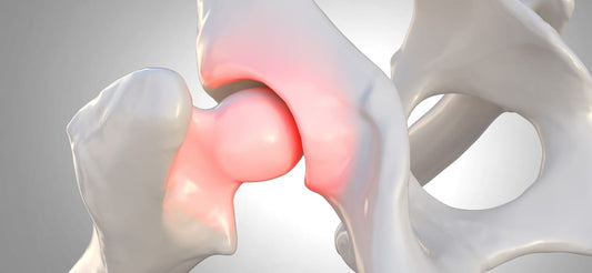 Hip--Dysplasia